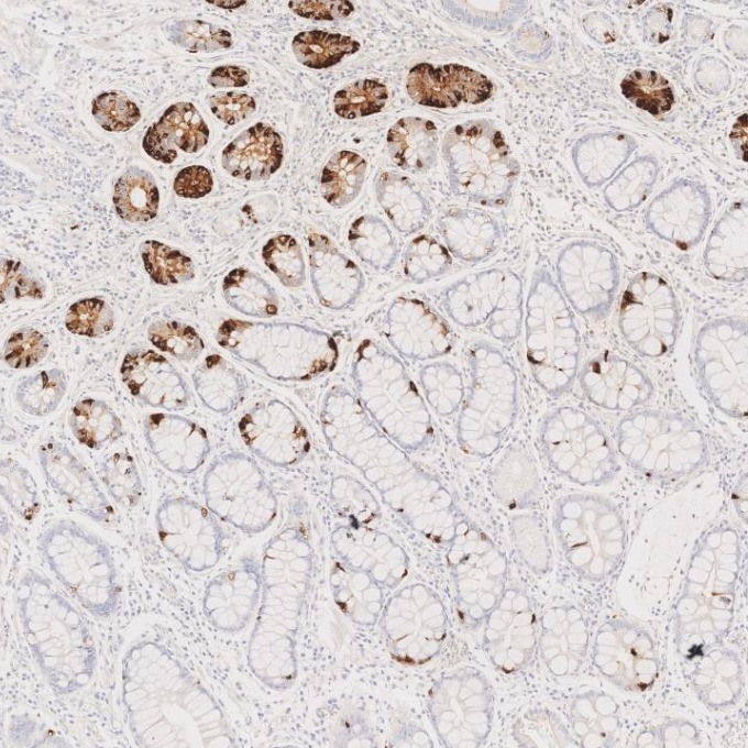 IHC staining of human stomach cancer using 85605-2-RR IHC staining of human stomach cancer using 85605-2-RR