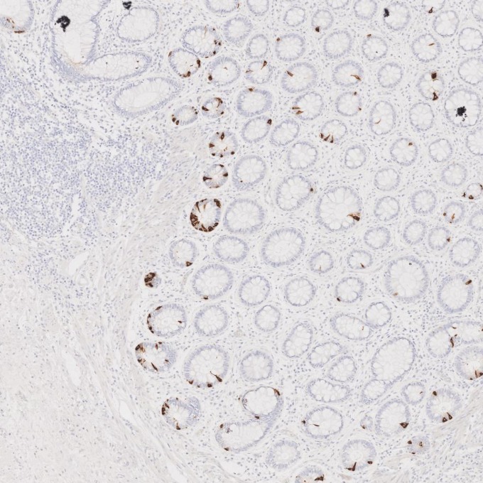 IHC staining of human colorectal cancer using 85605-2-RR IHC staining of human colorectal cancer using 85605-2-RR