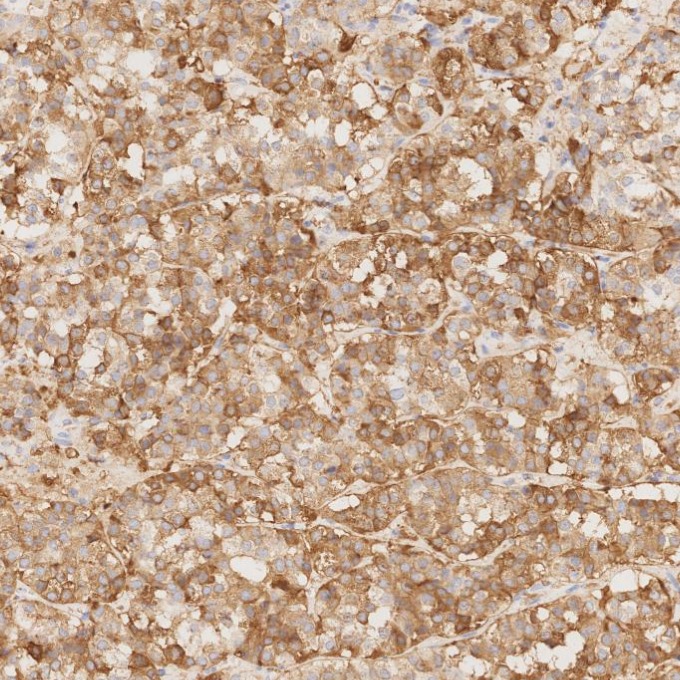 IHC staining of human pituitary adenoma using 85605-2-RR IHC staining of human pituitary adenoma using 85605-2-RR