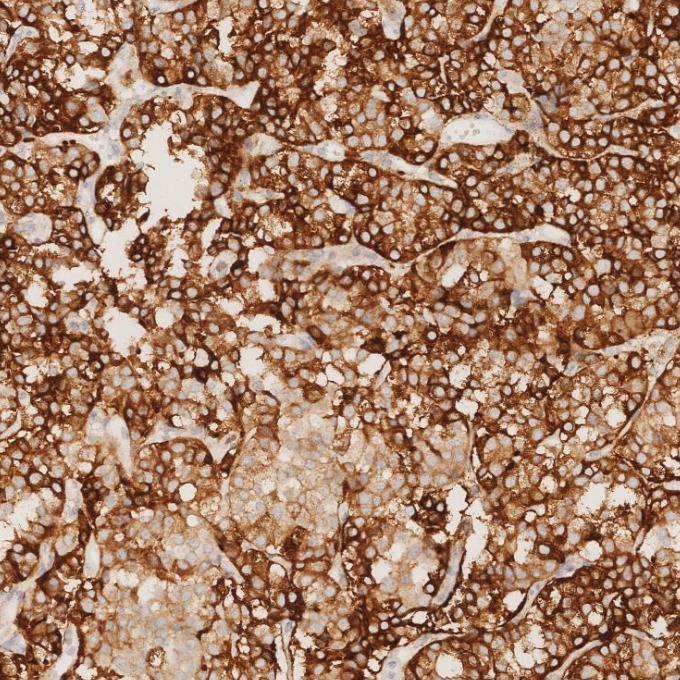 IHC staining of human pituitary adenoma using 85605-2-RR IHC staining of human pituitary adenoma using 85605-2-RR