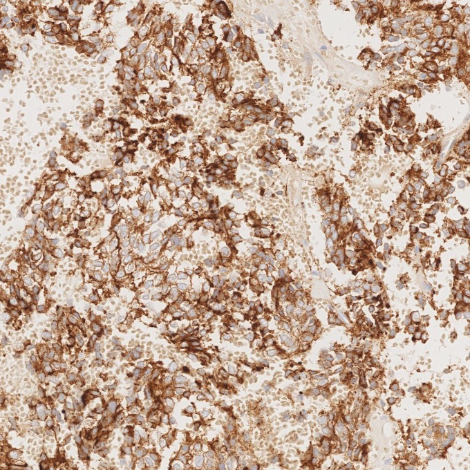 IHC staining of human pituitary adenoma using 85605-2-RR IHC staining of human pituitary adenoma using 85605-2-RR