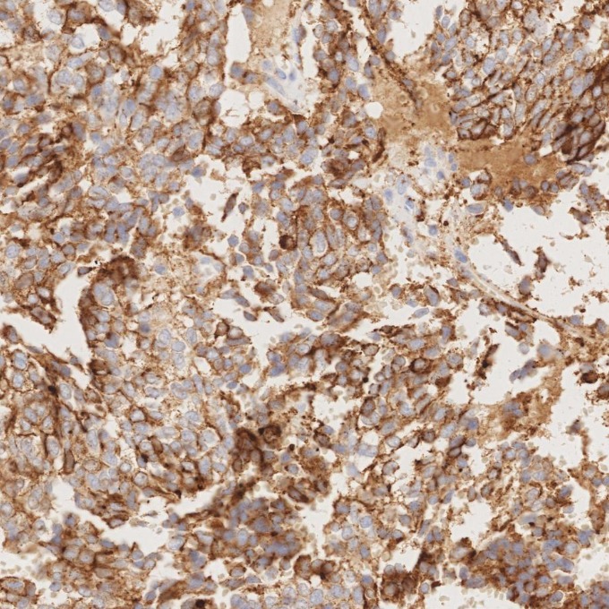 IHC staining of human pituitary adenoma using 85605-2-RR IHC staining of human pituitary adenoma using 85605-2-RR