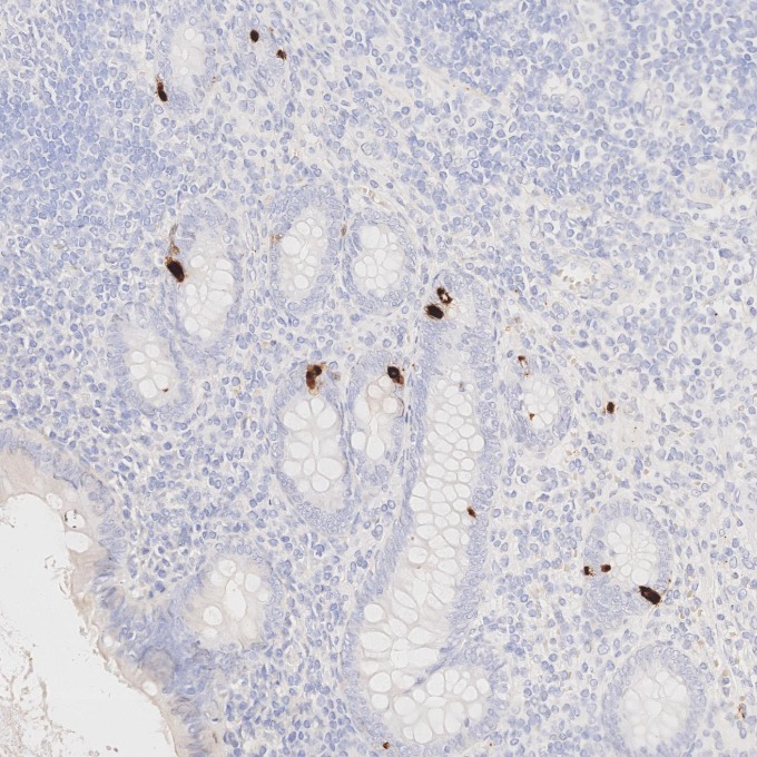 IHC staining of human appendicitis using 85605-2-RR IHC staining of human appendicitis using 85605-2-RR