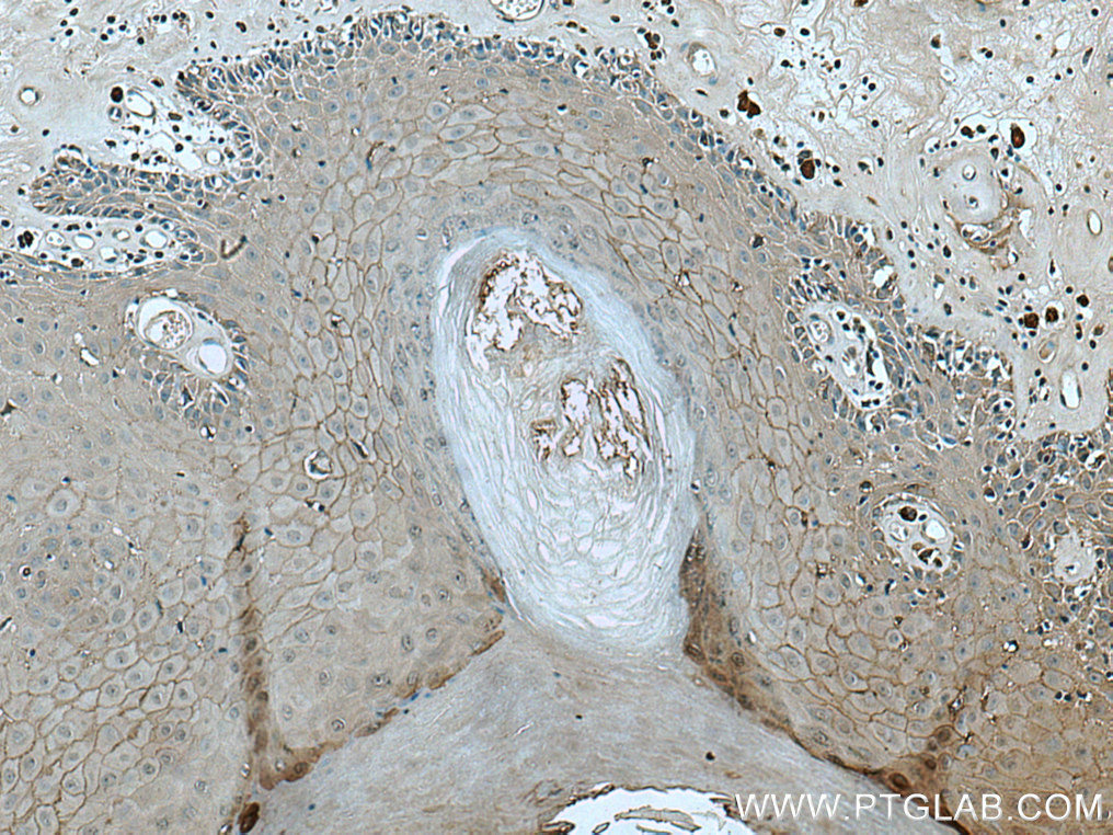 IHC staining of human skin cancer using 28674-1-AP