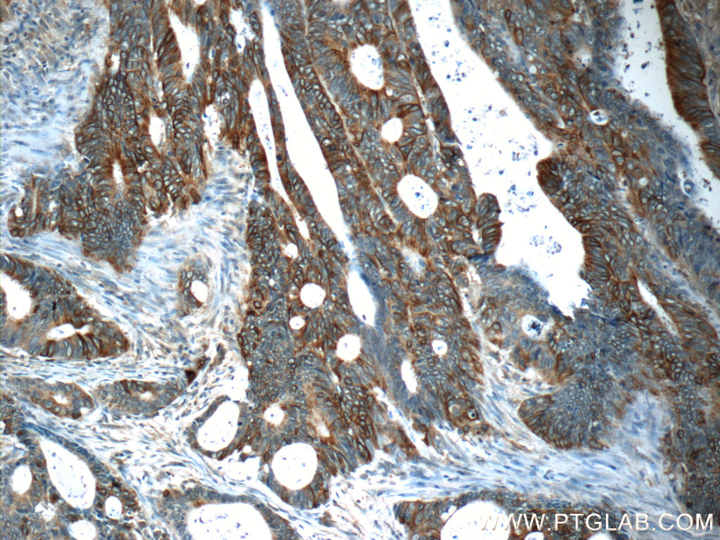 IHC staining of human colon cancer using 25296-1-AP