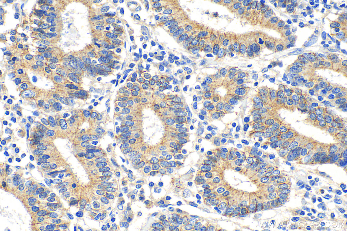 IHC staining of human endometrial cancer using 30520-1-AP (same clone as 30520-1-PBS)