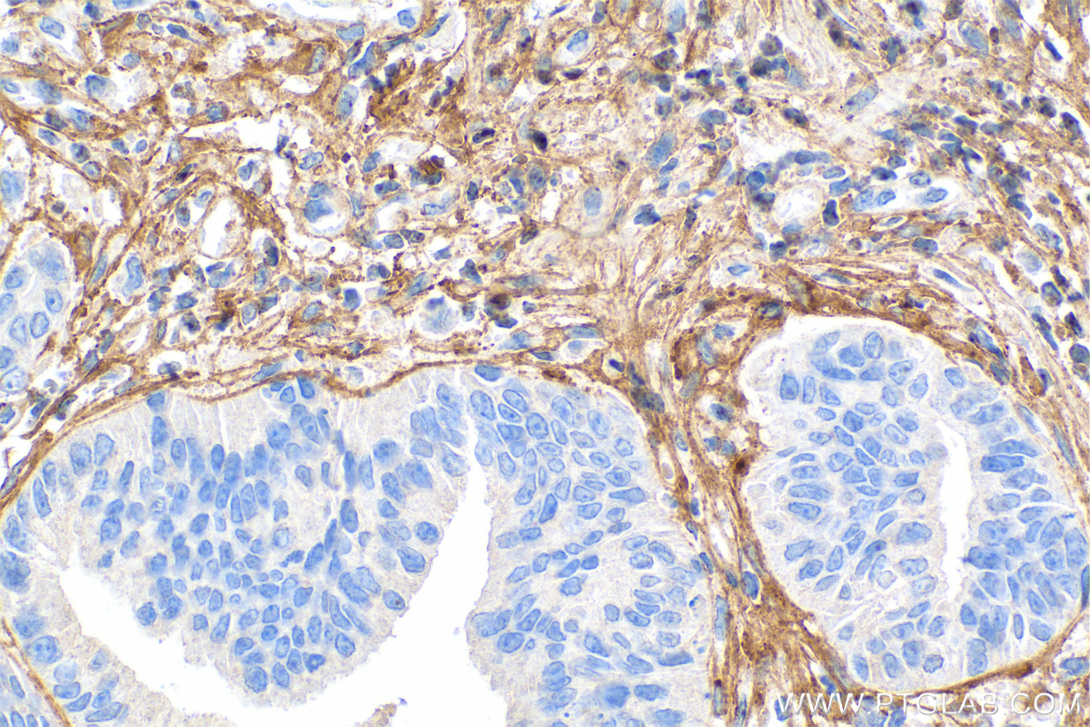 IHC staining of human colon cancer using 67288-1-Ig