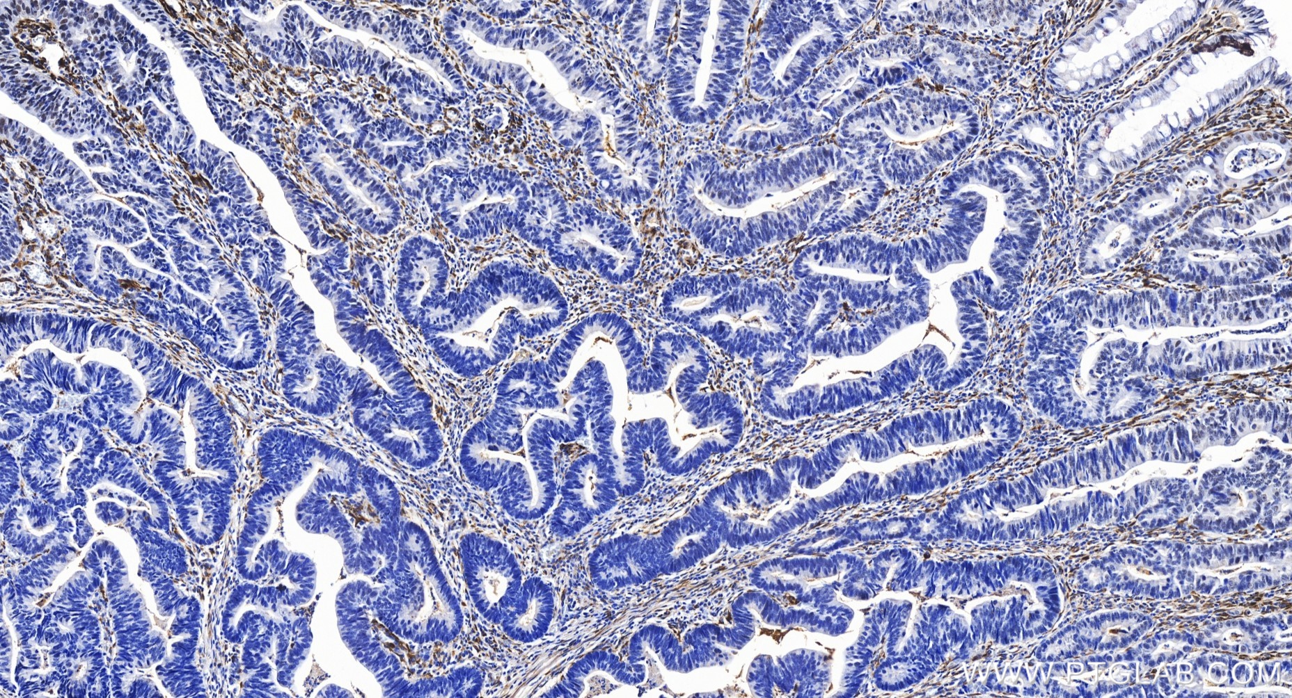 IHC staining of human colon cancer using 86093-1-RR