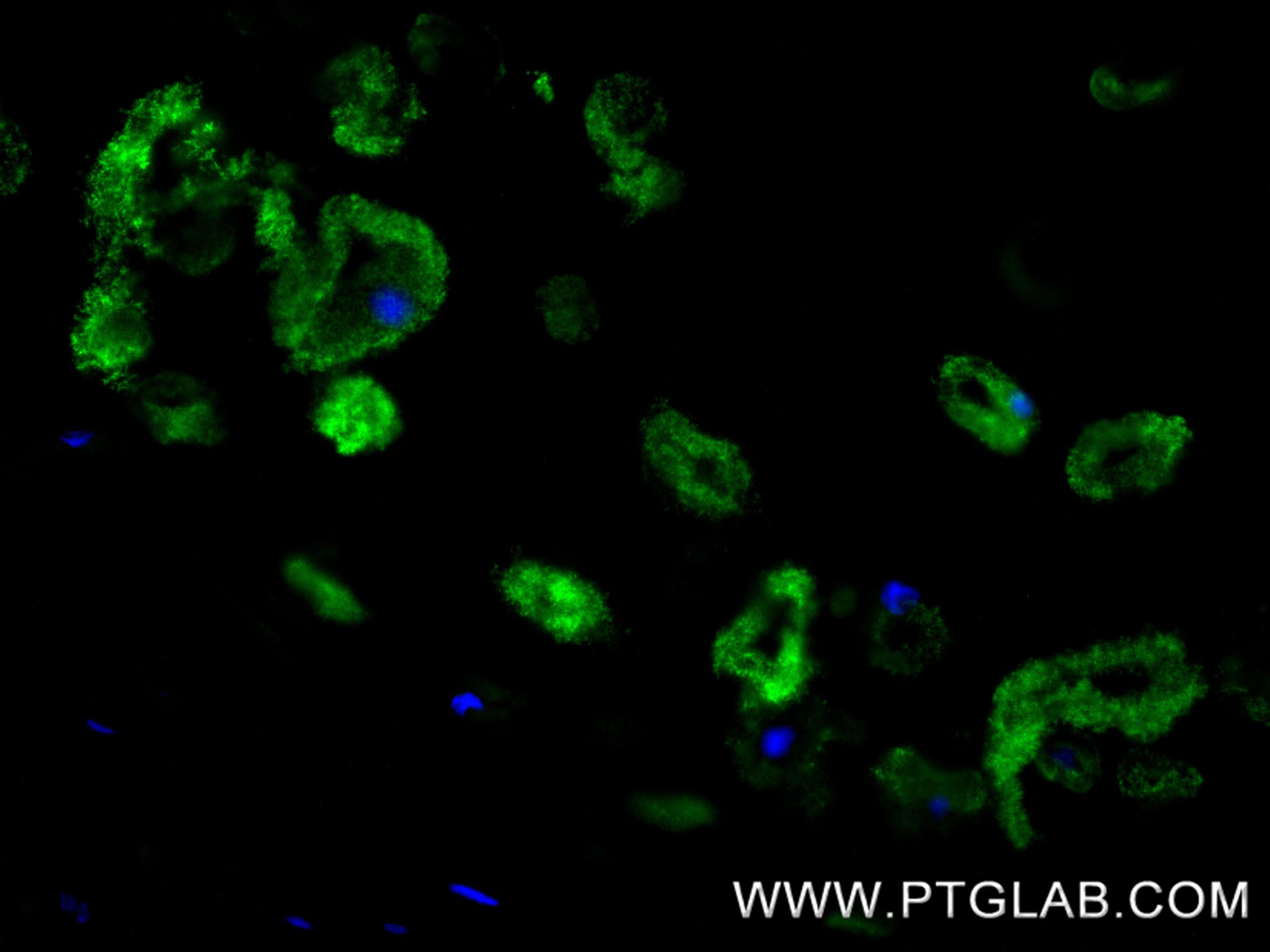 IF Staining of human lung cancer using 86139-2-RR (same clone as 86139-2-PBS) IF Staining of human lung cancer using 86139-2-RR (same clone as 86139-2-PBS)