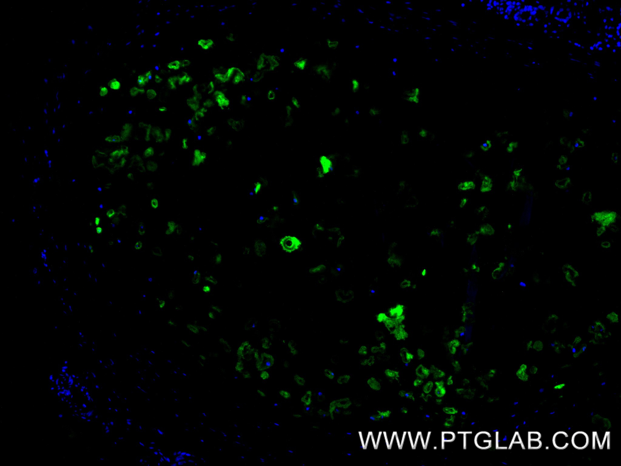 IF Staining of human lung cancer using 86139-2-RR (same clone as 86139-2-PBS) IF Staining of human lung cancer using 86139-2-RR (same clone as 86139-2-PBS)