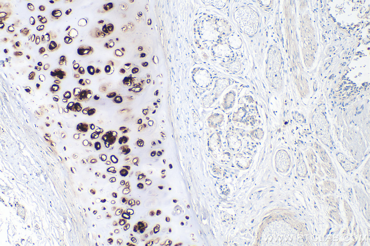 IHC staining of human lung cancer using 86139-2-RR