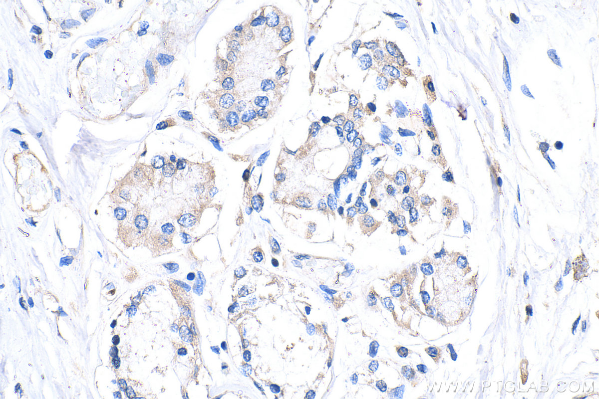IHC staining of human lung cancer using 86139-2-RR