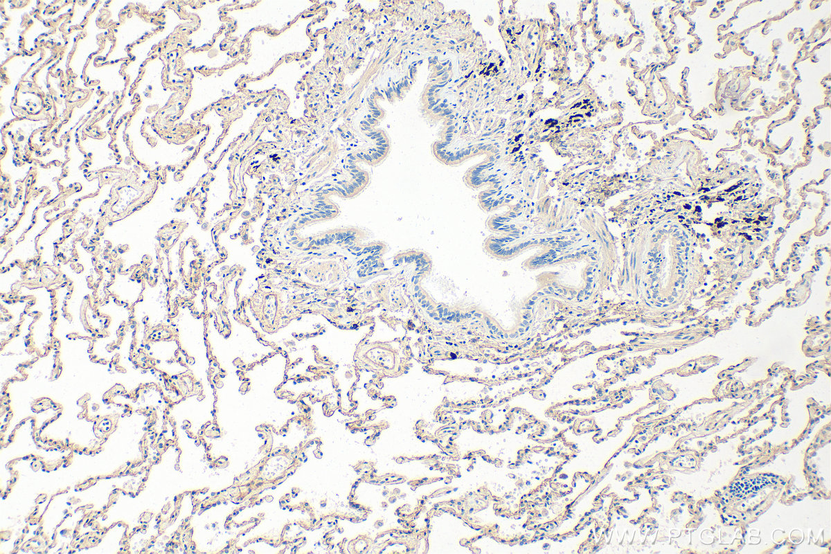IHC staining of human lung cancer using 30850-1-AP