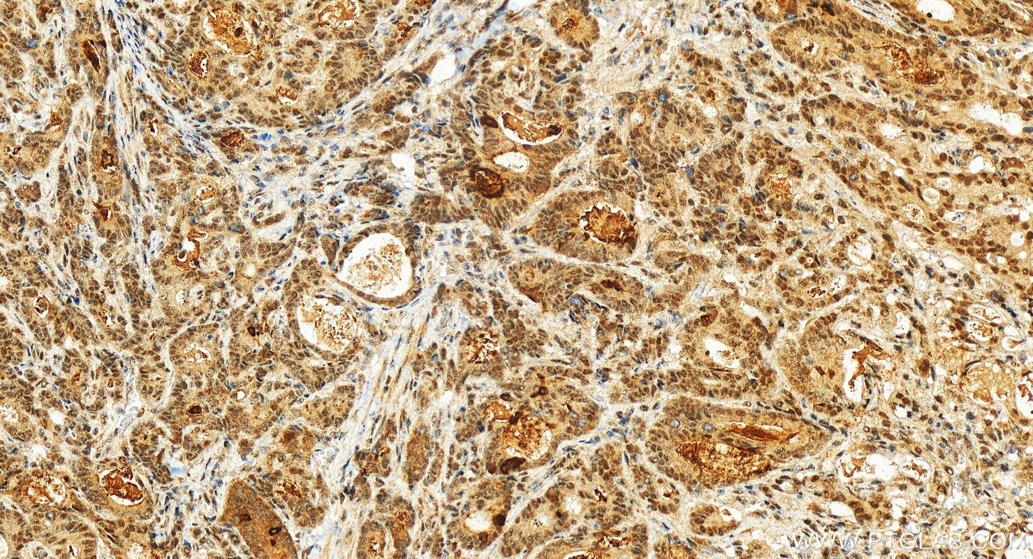 IHC staining of human stomach cancer using 24401-1-AP