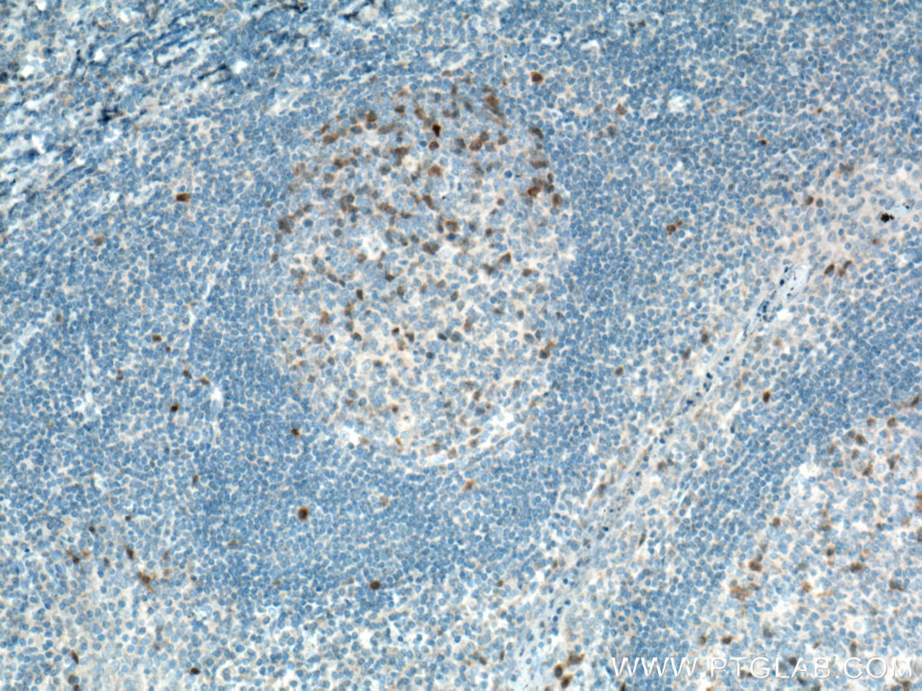 IHC staining of human tonsillitis using 66391-1-Ig