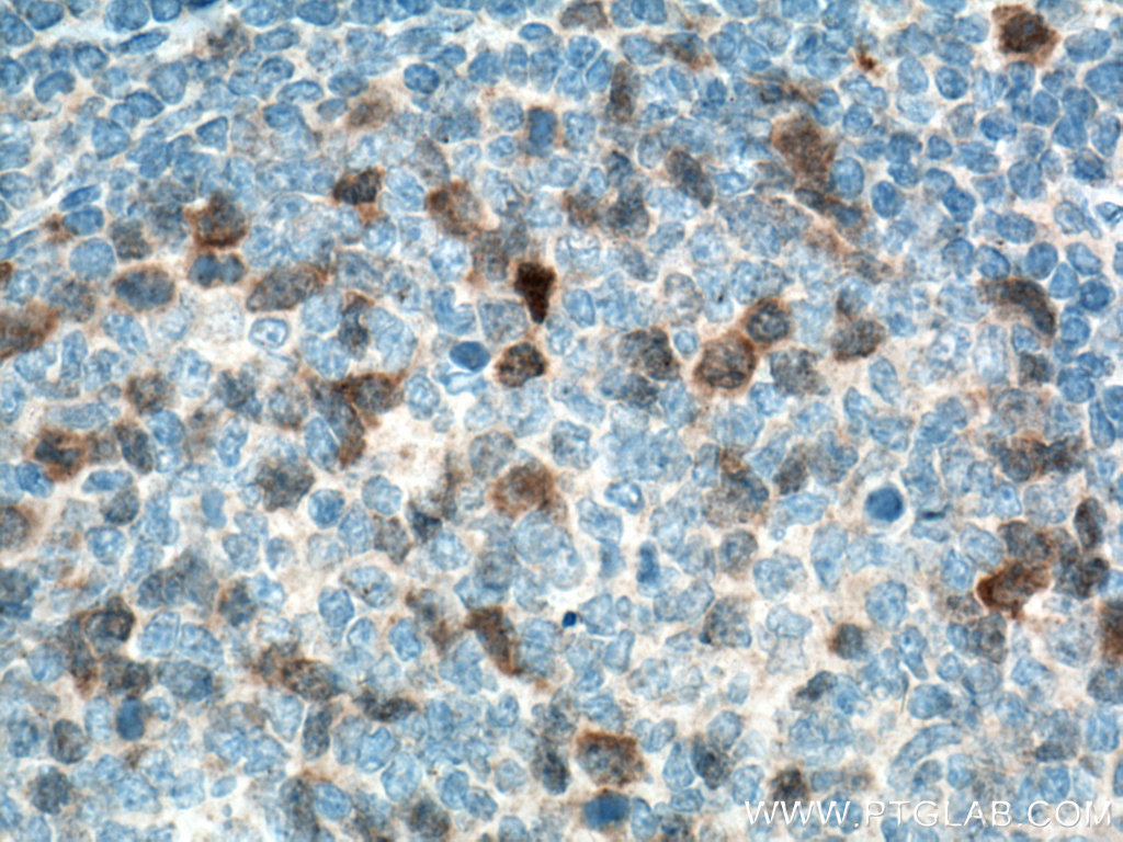 IHC staining of human tonsillitis using 66391-1-Ig