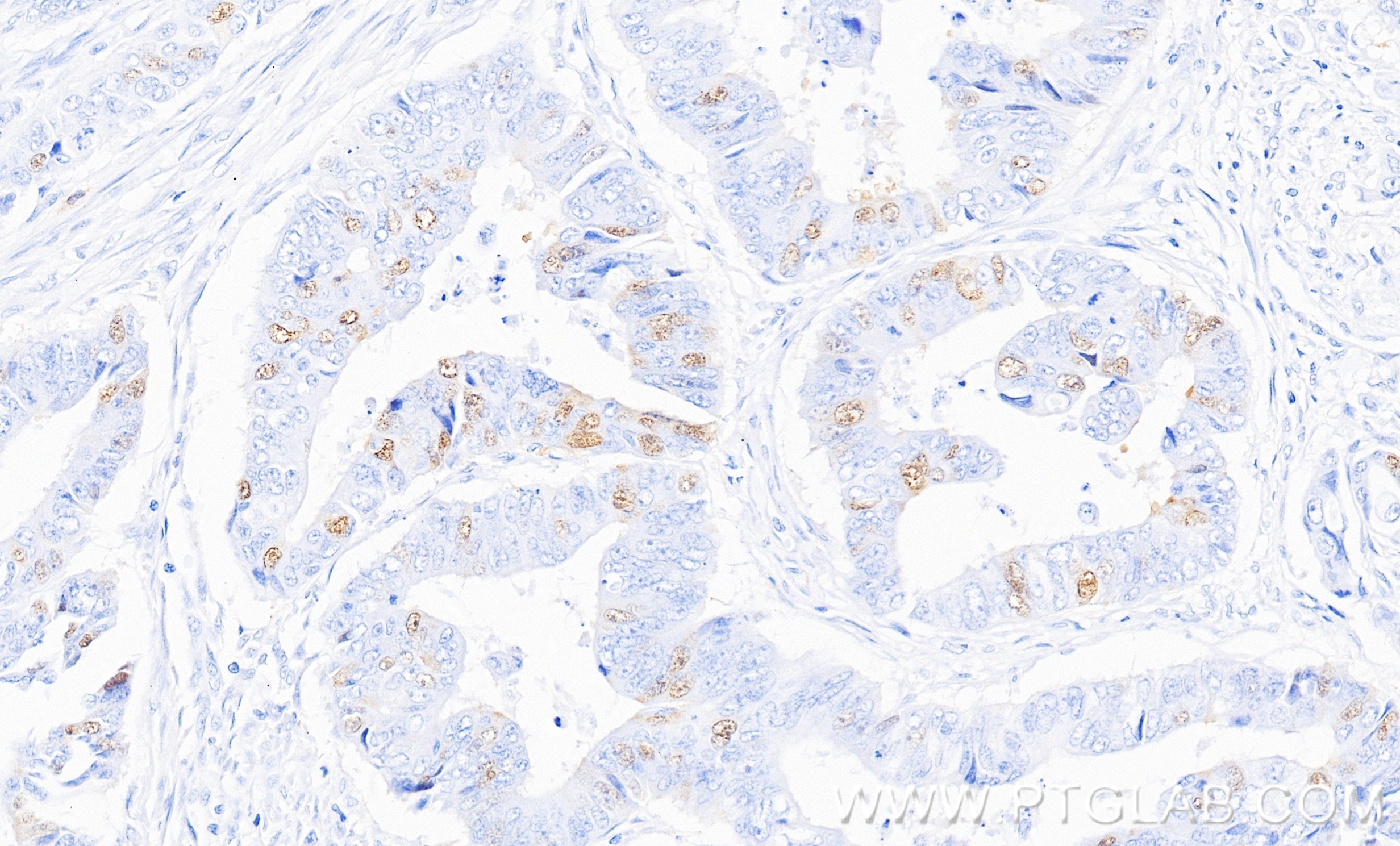 IHC staining of human colon cancer using 82148-1-RR IHC staining of human colon cancer using 82148-1-RR