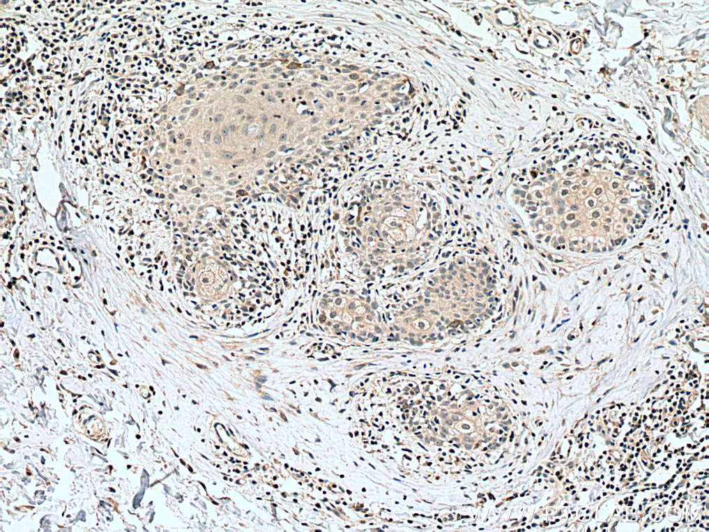 IHC staining of human skin cancer using 28603-1-AP