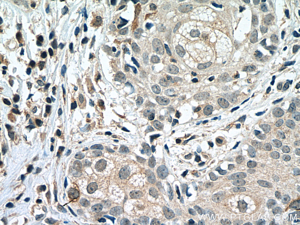 IHC staining of human skin cancer using 28603-1-AP