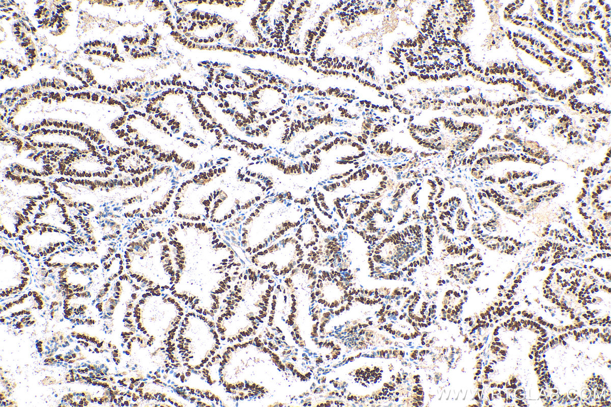 IHC staining of human ovary tumor using 26939-1-AP