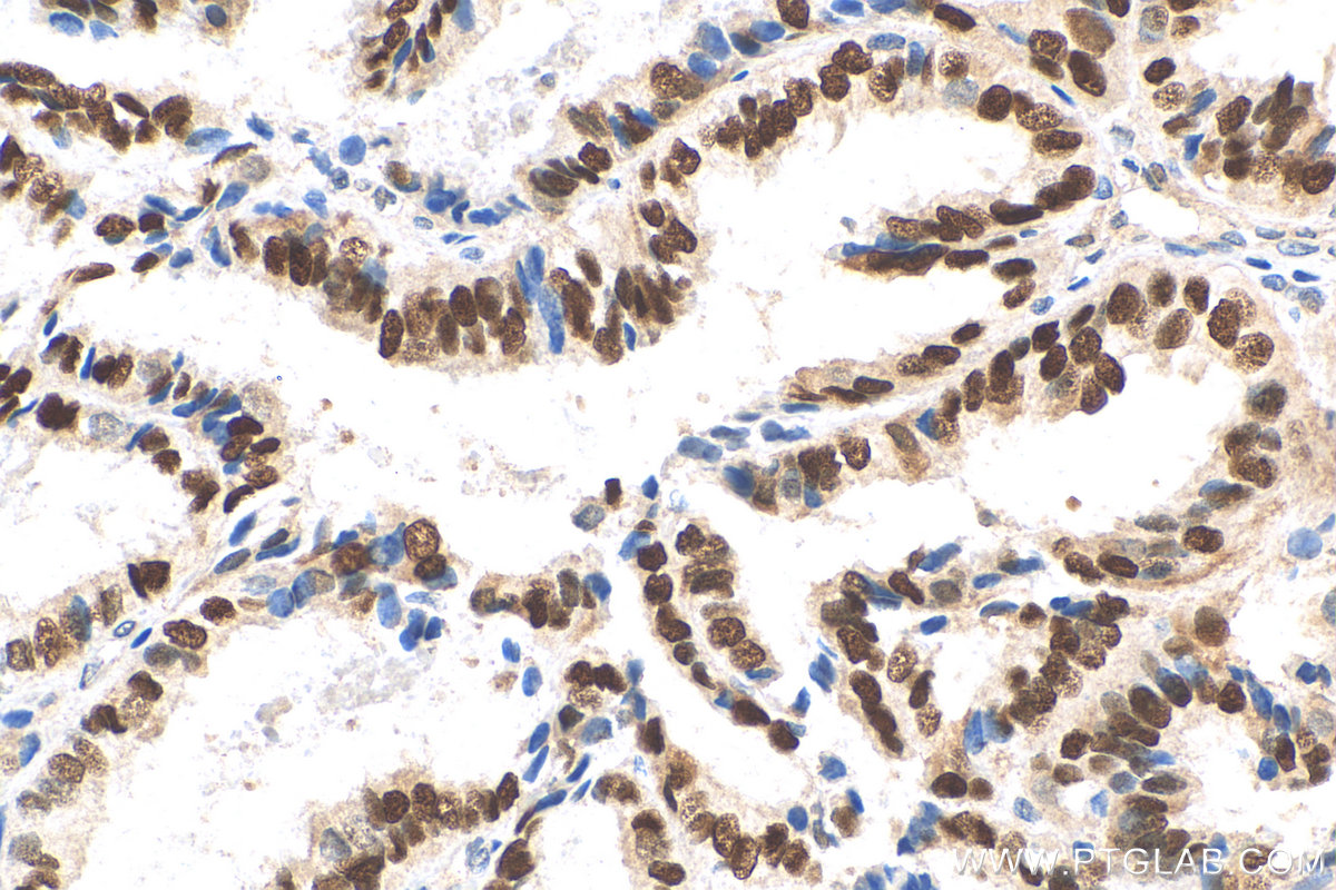 IHC staining of human ovary tumor using 26939-1-AP