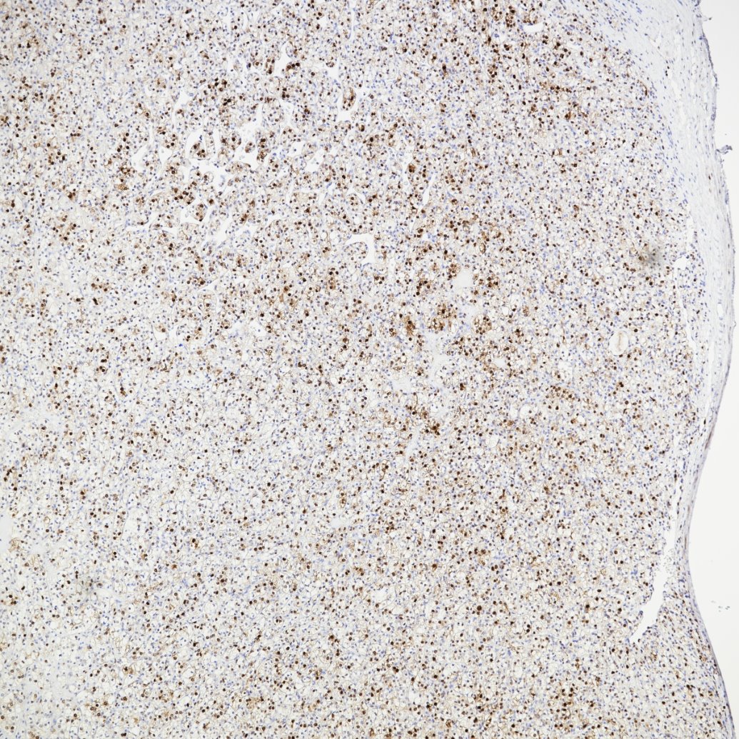 IHC staining of human renal cell carcinoma using 82681-1-RR