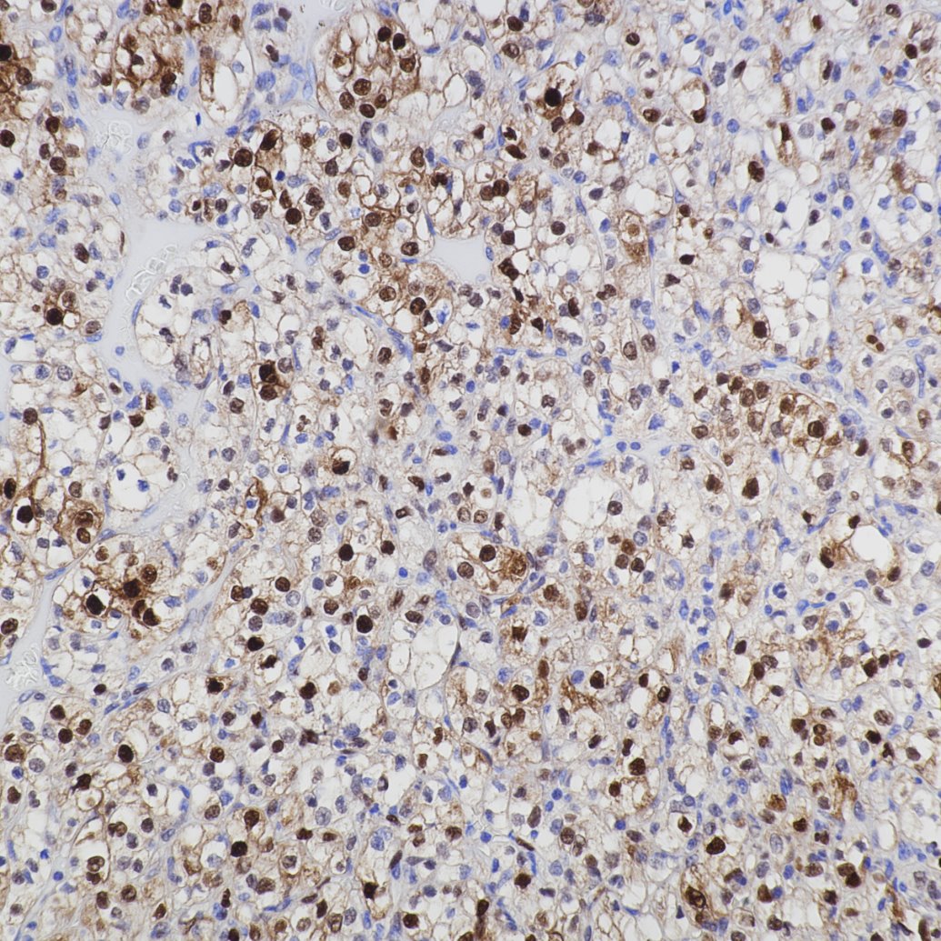IHC staining of human renal cell carcinoma using 82681-1-RR
