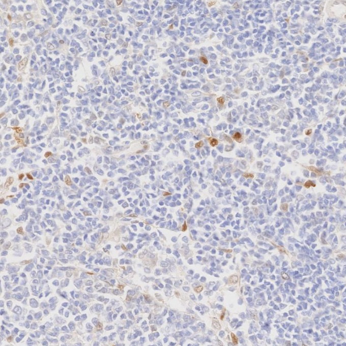 IHC staining of human lymphoma using 82681-1-RR