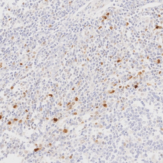 IHC staining of human lymphoma using 82681-1-RR