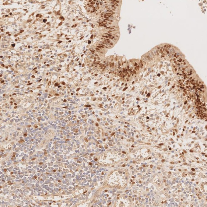 IHC staining of human lymphoma using 82681-1-RR