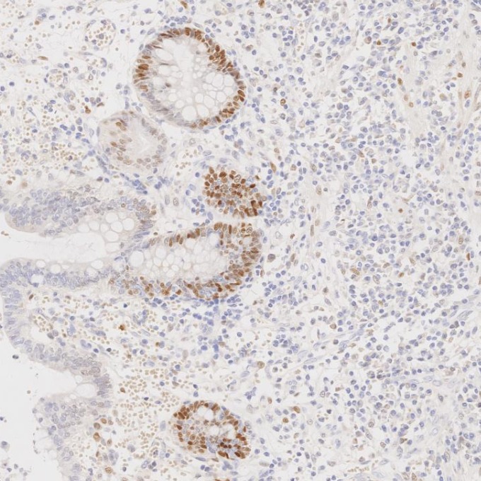 IHC staining of human lymphoma using 82681-1-RR