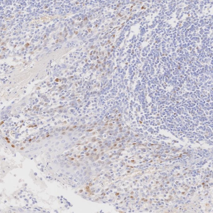 IHC staining of human tonsillitis using 82681-1-RR
