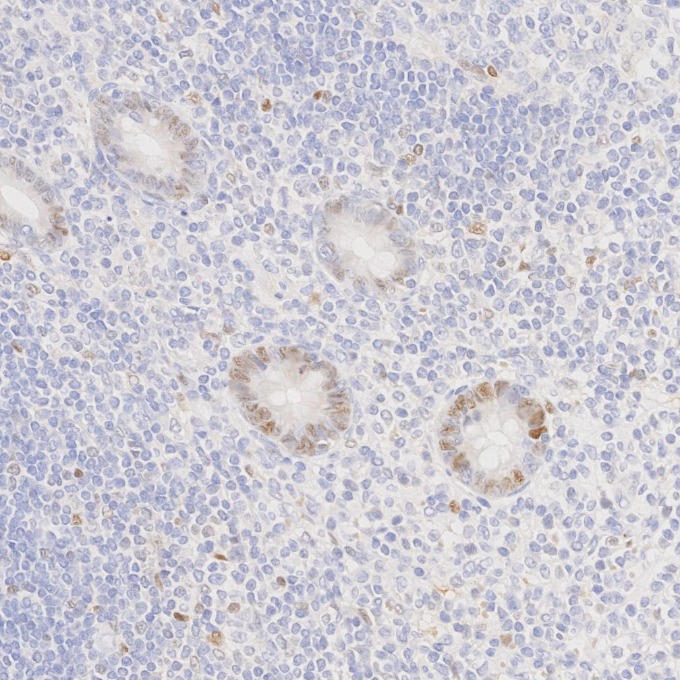 IHC staining of human appendicitis using 82681-1-RR