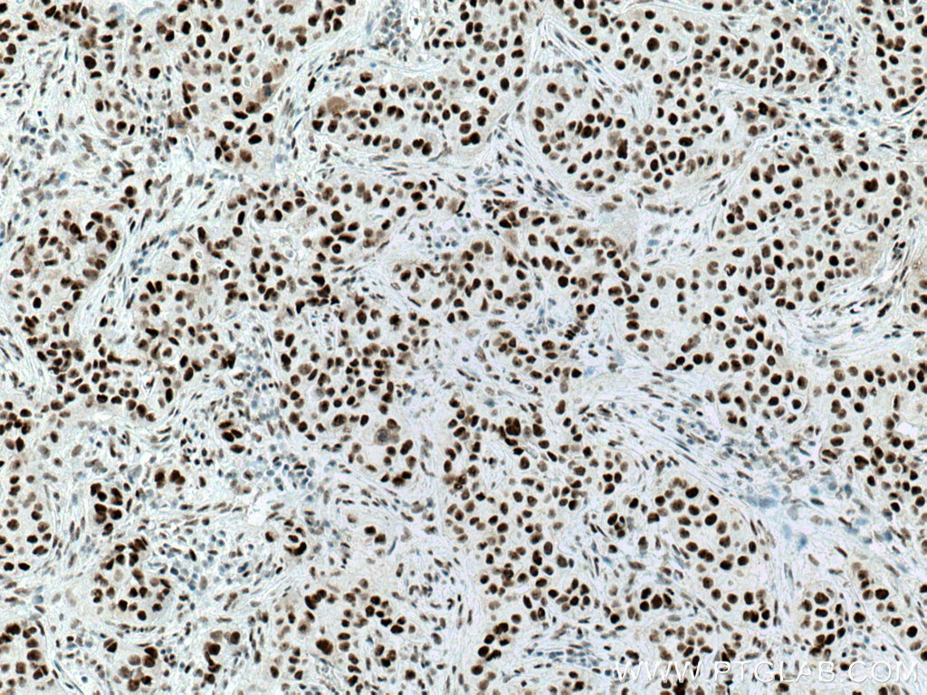 IHC staining of human breast cancer using 67065-1-Ig