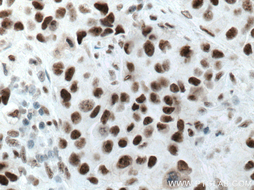 IHC staining of human breast cancer using 67065-1-Ig (same clone as 67065-1-PBS)