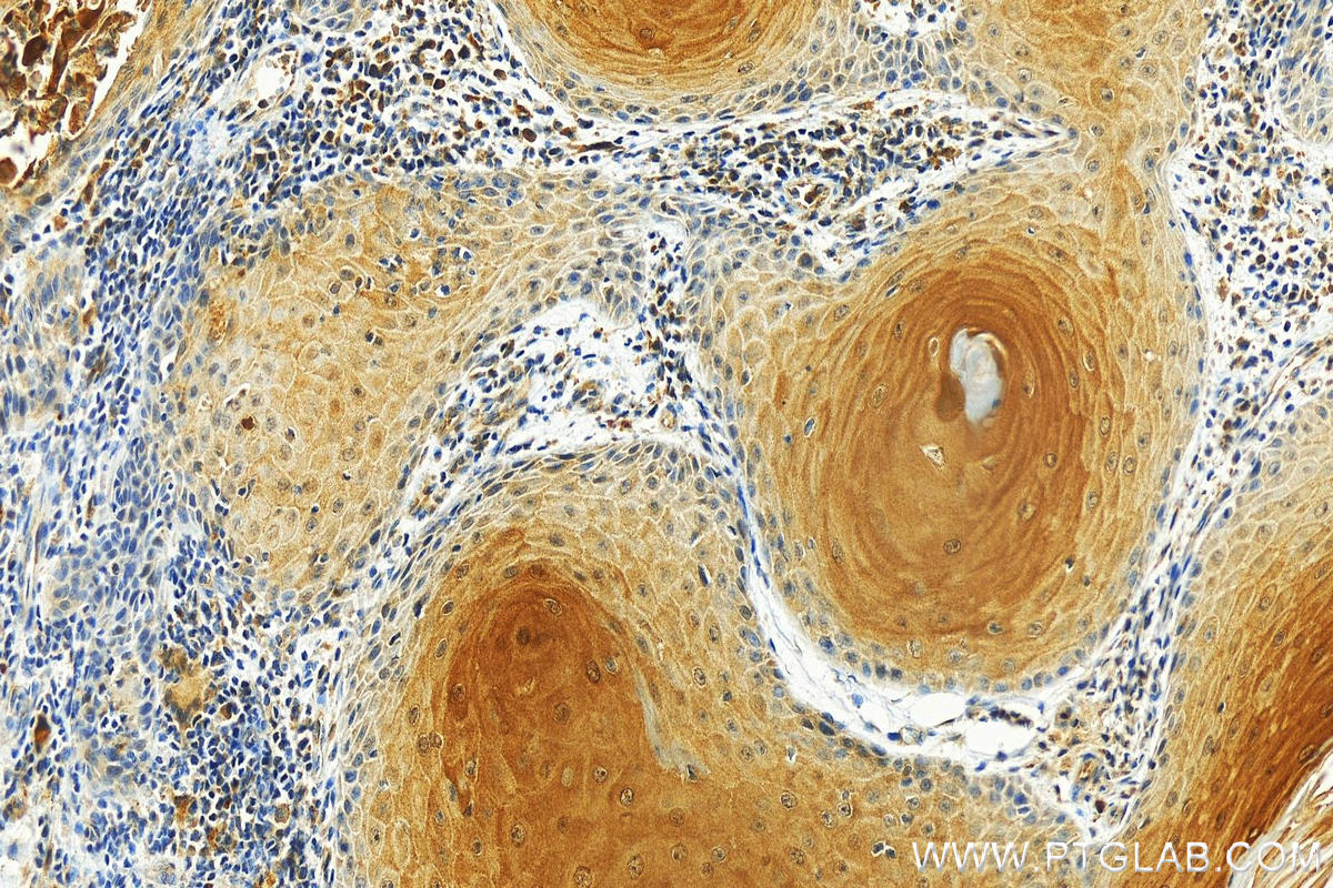 IHC staining of human skin cancer using 66812-1-Ig