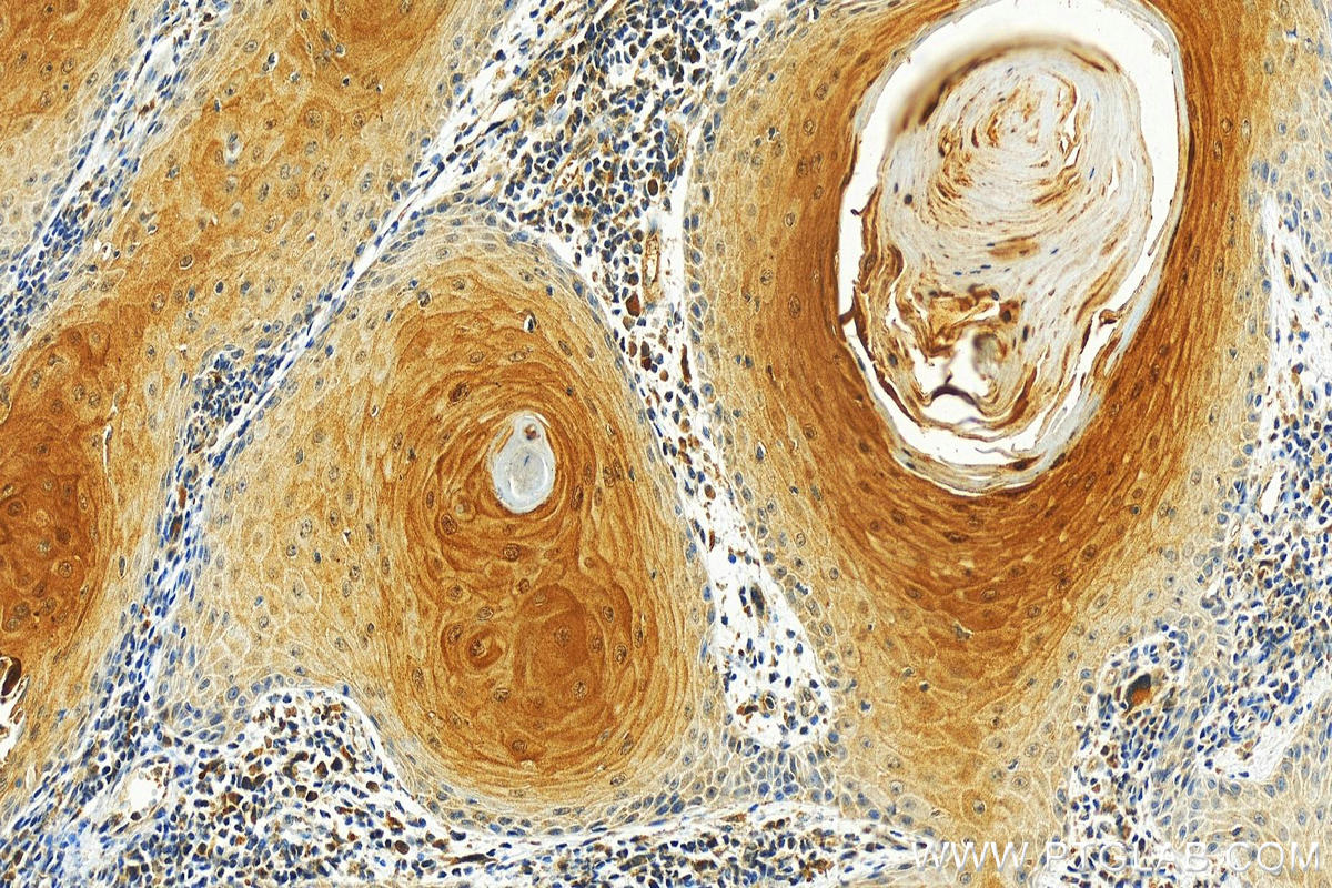 IHC staining of human skin cancer using 66812-1-Ig