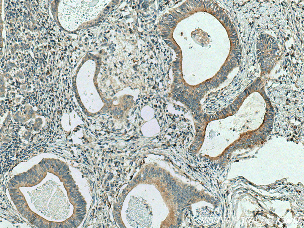 IHC staining of human stomach cancer using 26979-1-AP