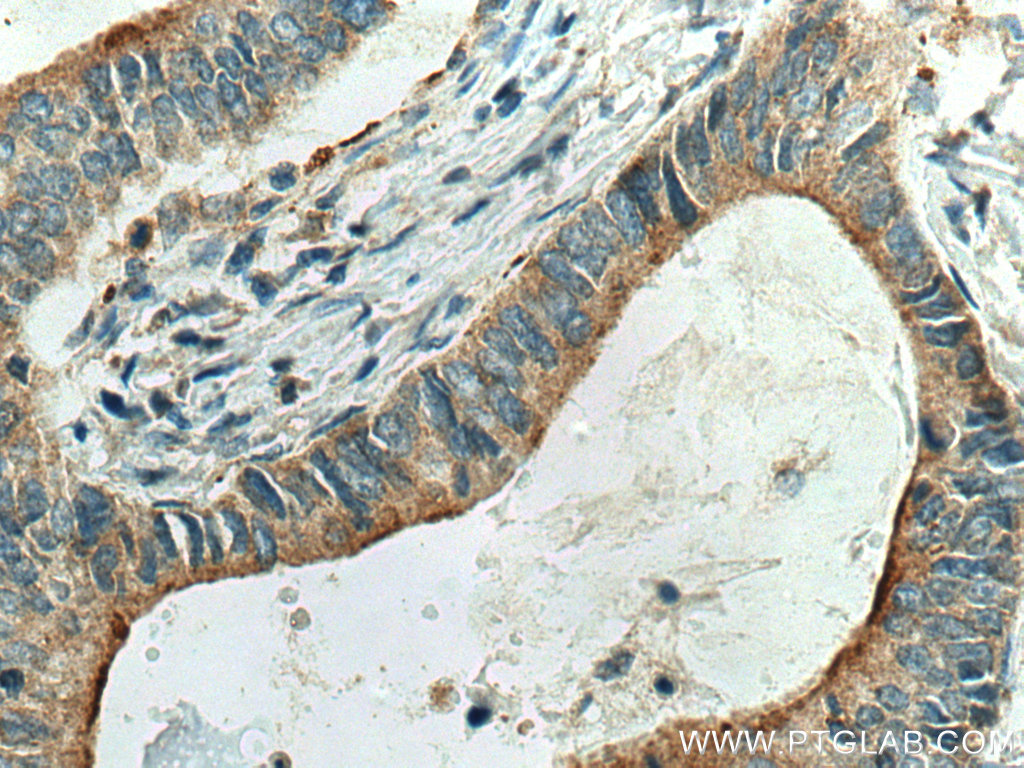 IHC staining of human stomach cancer using 26979-1-AP