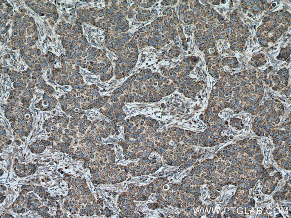 IHC staining of human breast cancer using 66264-1-Ig (same clone as 66264-1-PBS)