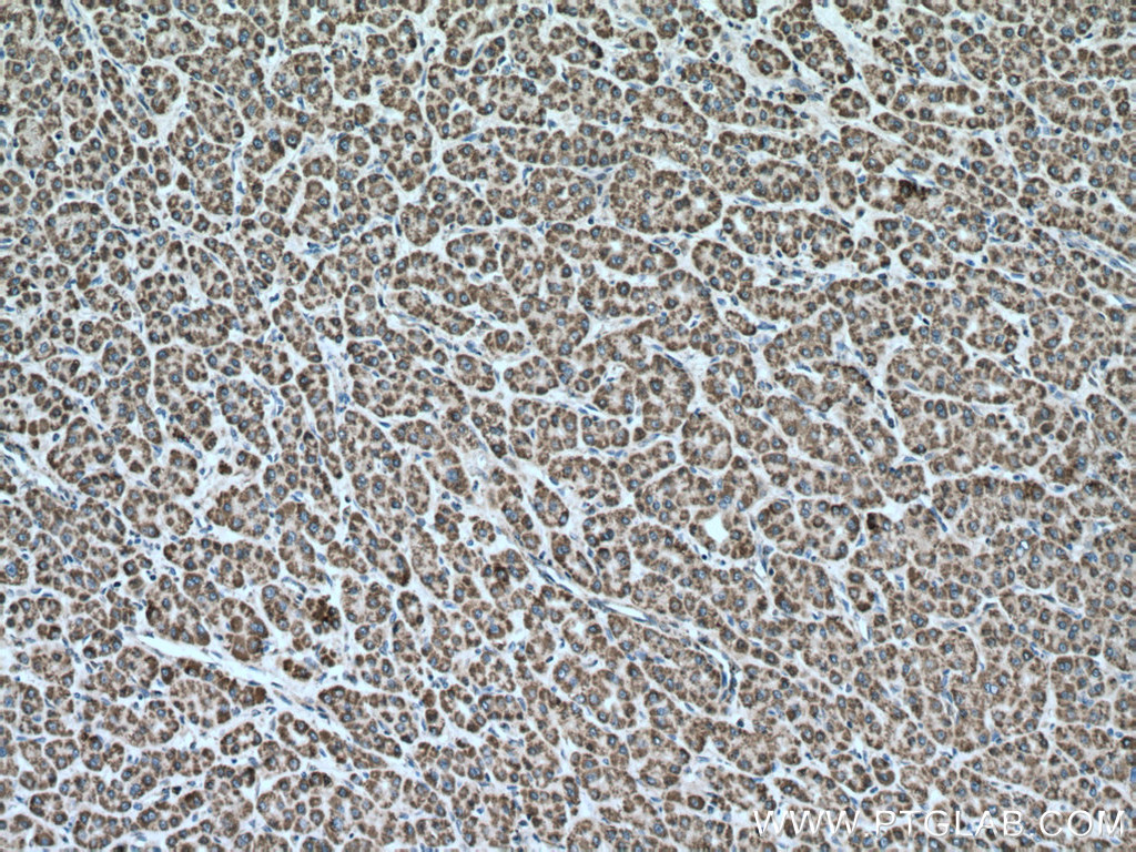 IHC staining of human liver cancer using 66264-1-Ig (same clone as 66264-1-PBS)