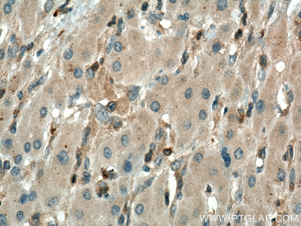 IHC staining of human liver cancer using 67185-1-Ig