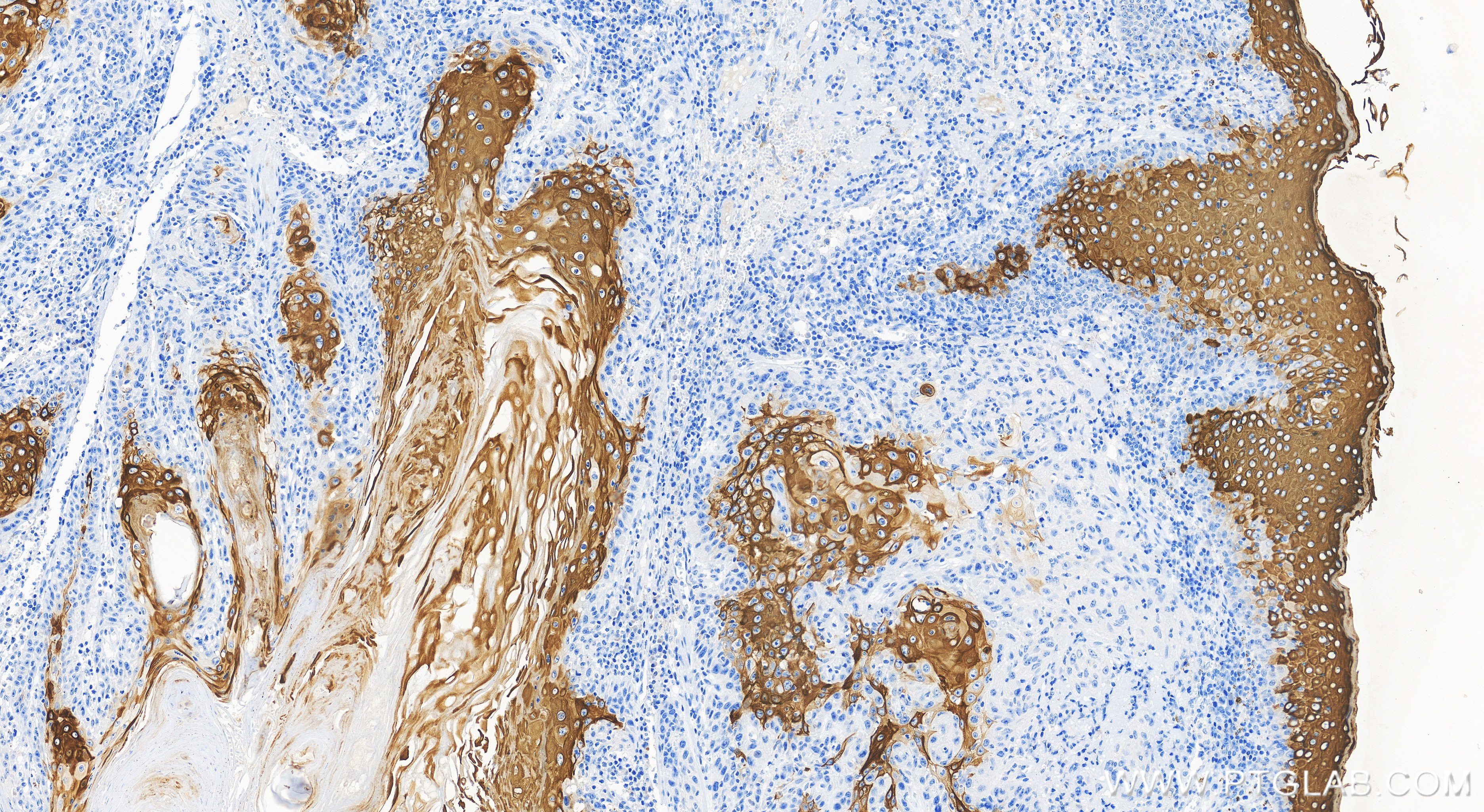 IHC staining of human skin cancer using 86324-1-RR