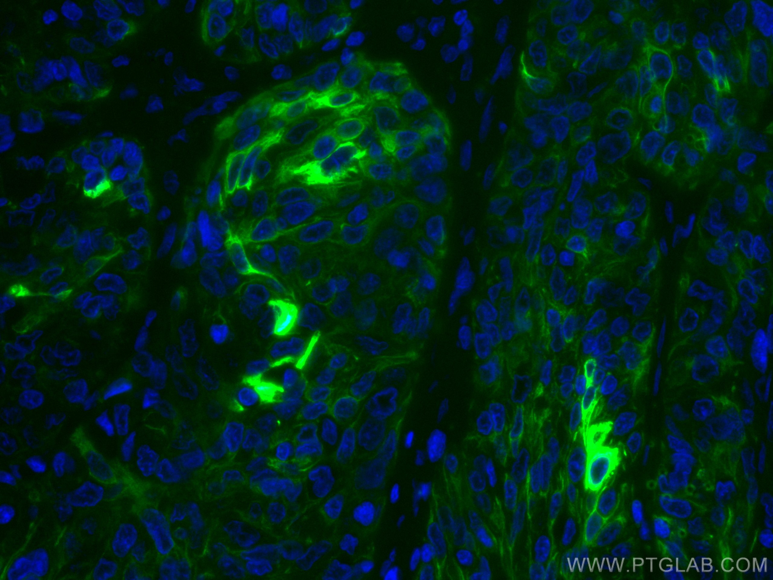 IF Staining of human cervical cancer using CL488-66684