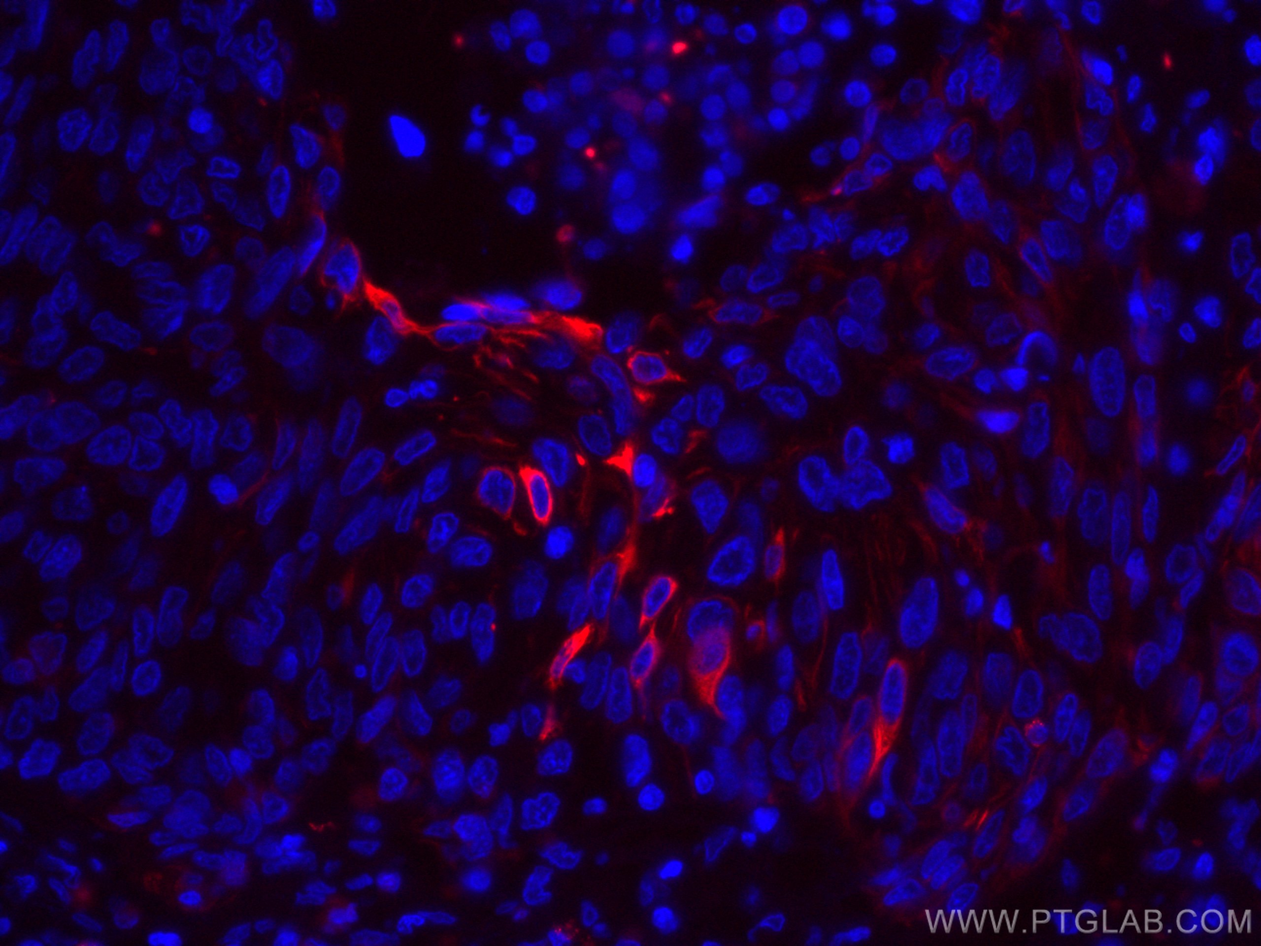 IF Staining of human cervical cancer using CL594-66684