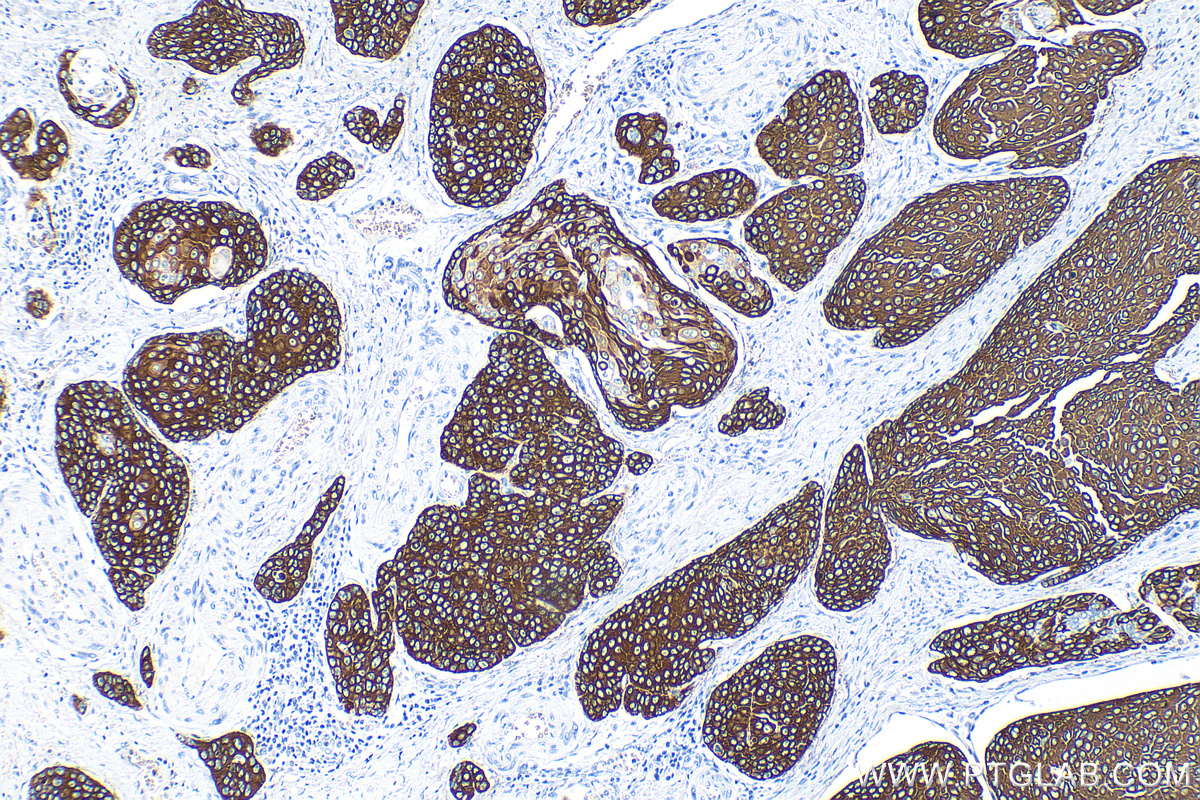 IHC staining of human oesophagus cancer using 82824-1-RR