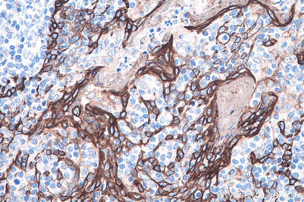 IHC staining of human tonsillitis using 66802-1-Ig