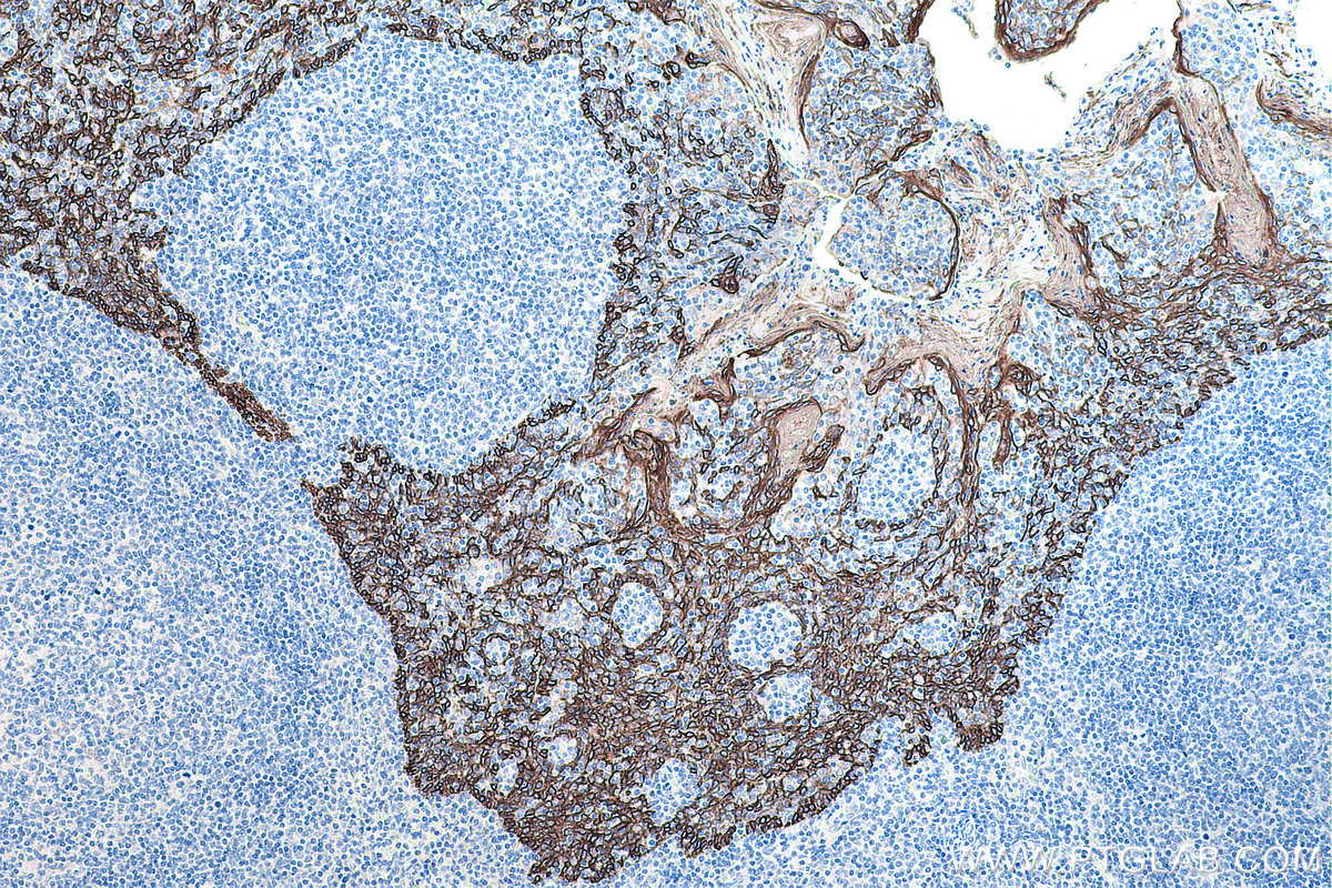 IHC staining of human tonsillitis using 66802-1-Ig (same clone as 66802-1-PBS)