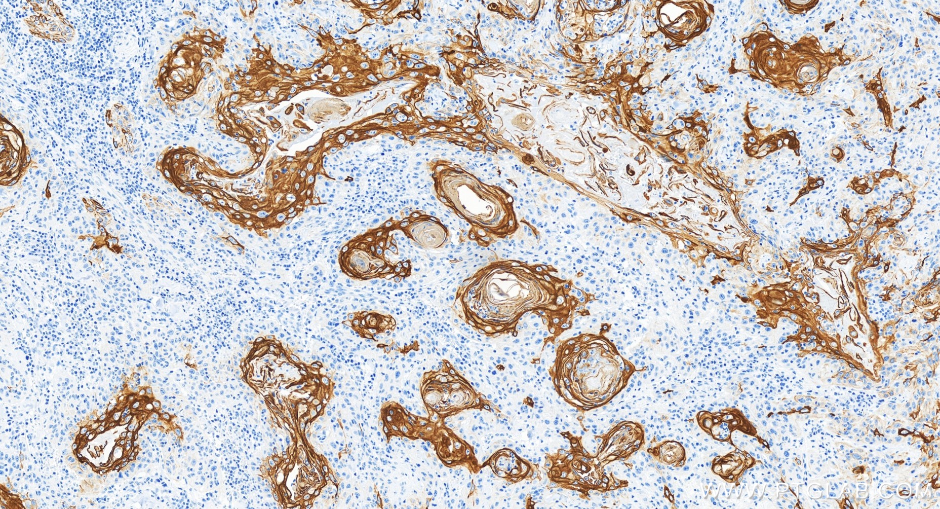 IHC staining of human skin cancer using 84978-1-RR