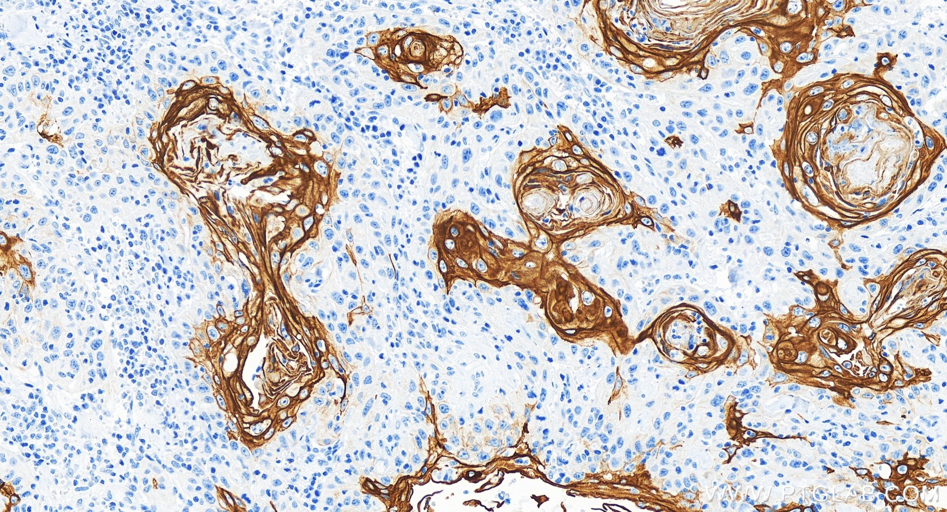 IHC staining of human skin cancer using 84978-1-RR
